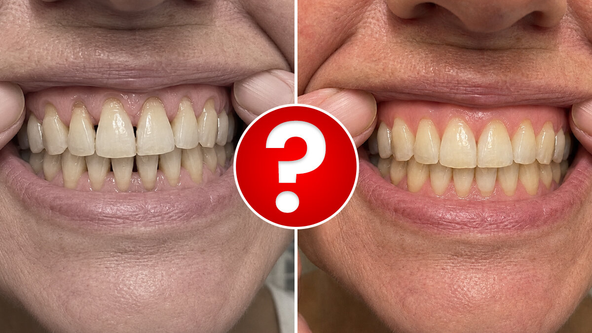Can Receding Gums Really Grow Back? A London Dermatologist Says Yes, And It Comes Down To THIS One Thing Dentists Overlook